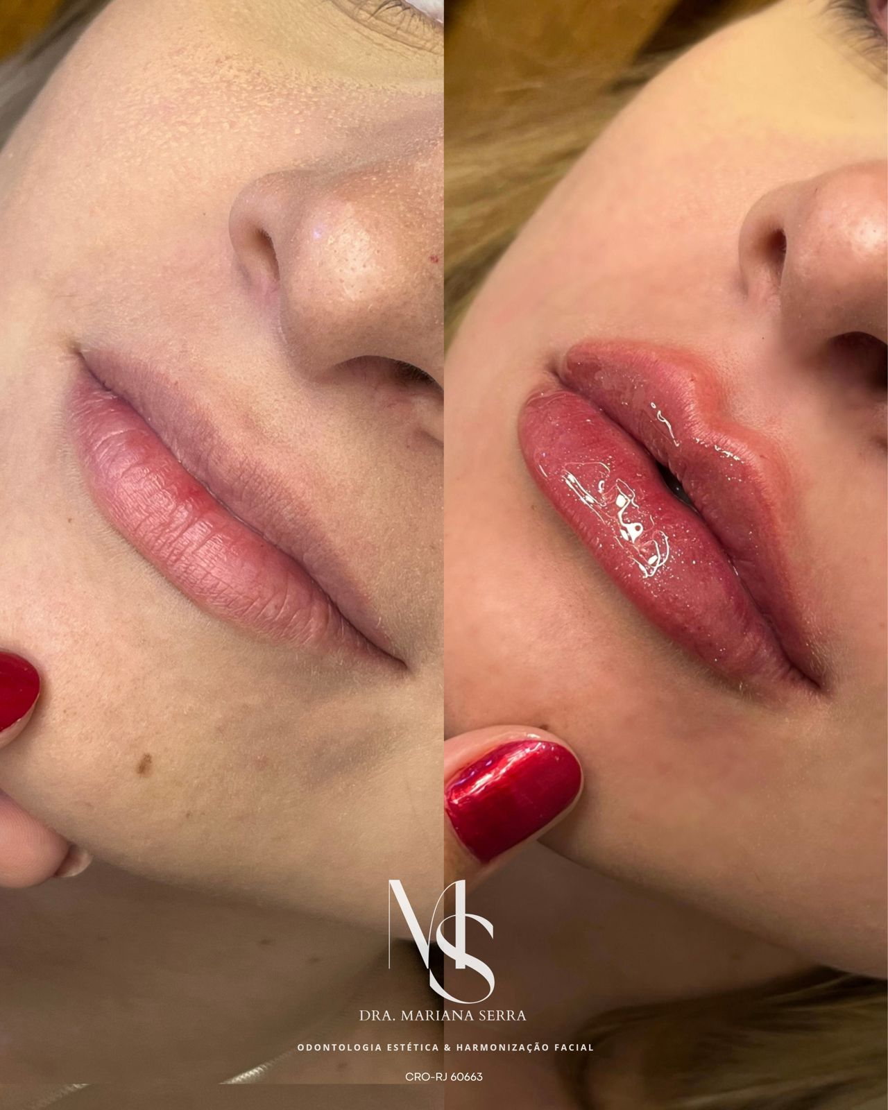 Preenchimento labial Exemplo 1 antes e depois
