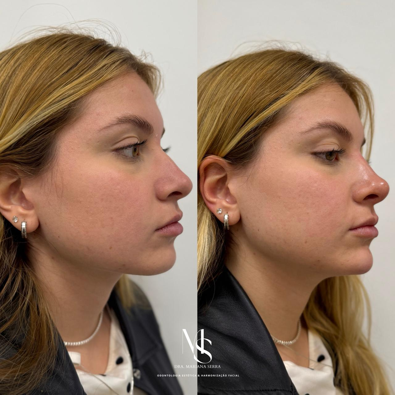 Perfiloplastia · caso 2