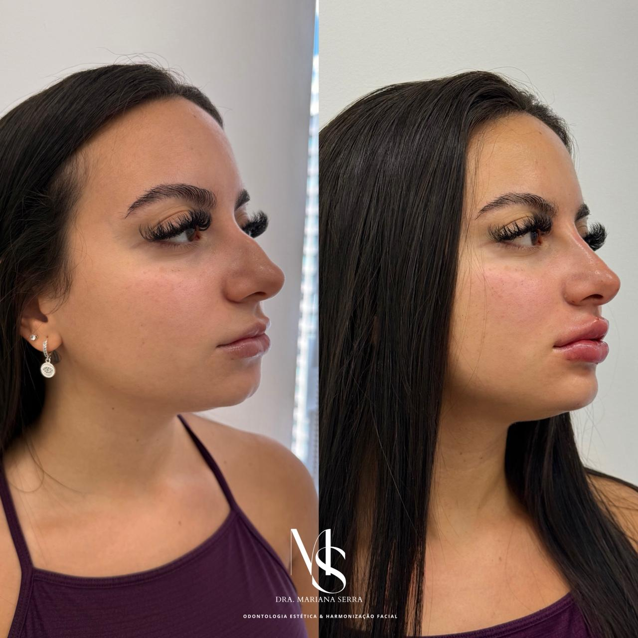 Perfiloplastia Exemplo 1 antes e depois