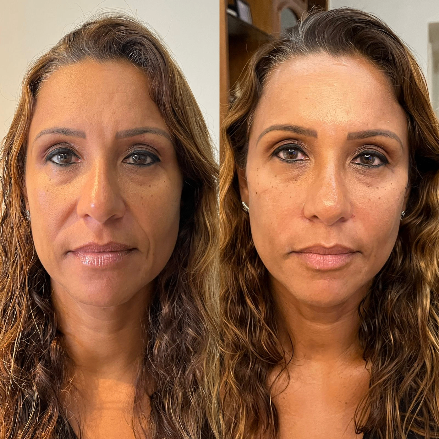 Full Face Exemplo 3 antes e depois
