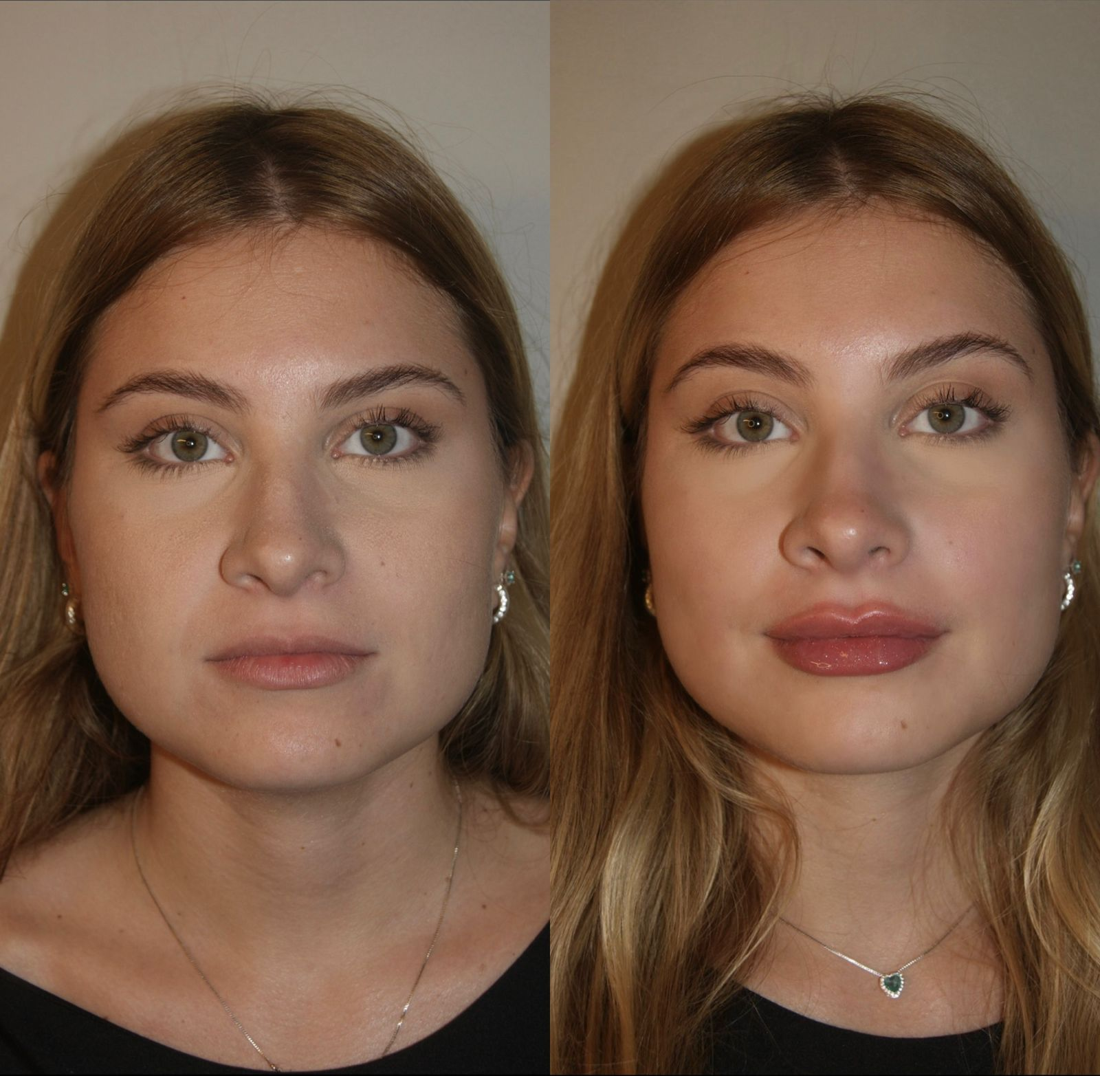 Full Face Exemplo 2 antes e depois