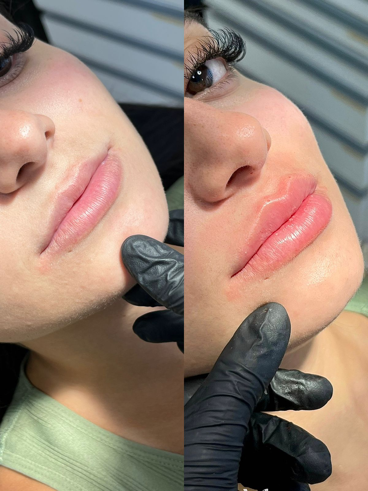 Preenchimento labial Exemplo 2 antes e depois